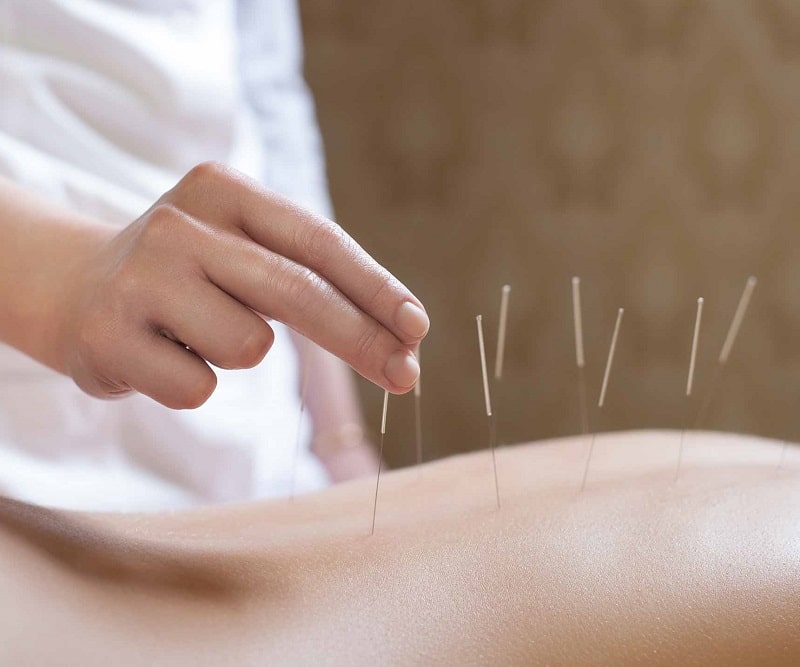 Acupuncture
