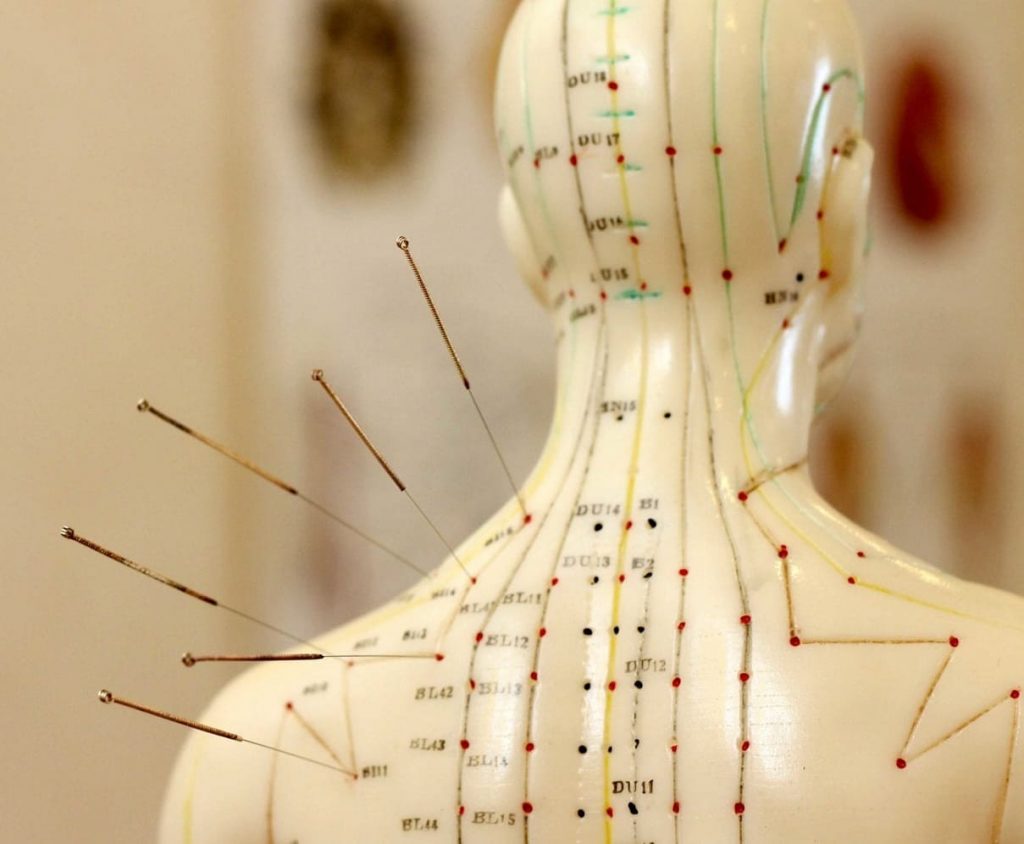 Acupuncture