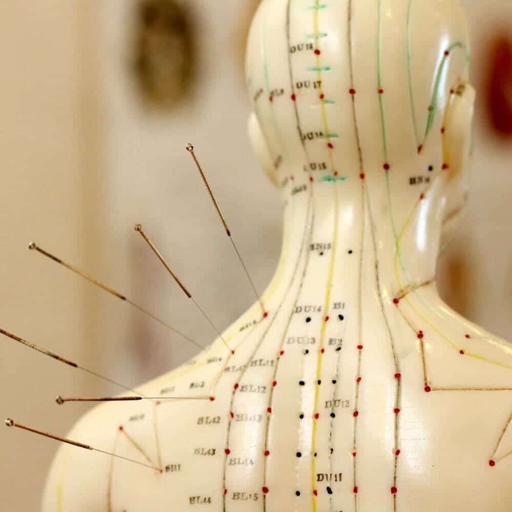 Acupuncture